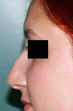 chirurgie-esthetique-interventions-nez-rhinoplasties-051