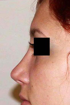 chirurgie-esthetique-interventions-nez-rhinoplasties-052