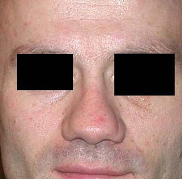 chirurgie-esthetique-interventions-nez-rhinoplasties-053