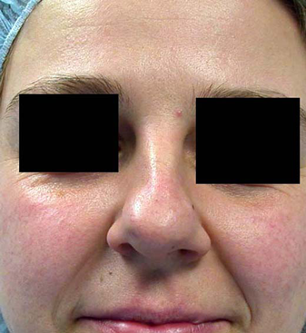 chirurgie-esthetique-interventions-nez-rhinoplasties-055