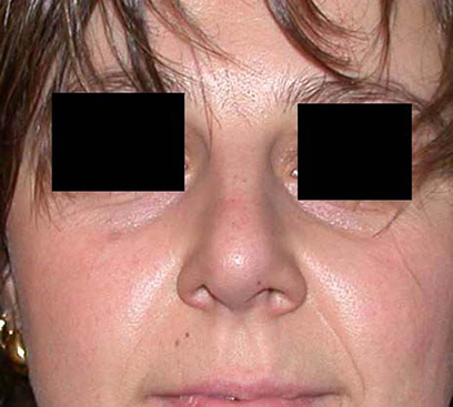 chirurgie-esthetique-interventions-nez-rhinoplasties-056