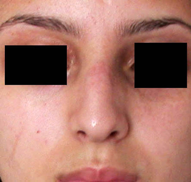 chirurgie-esthetique-interventions-nez-rhinoplasties-057