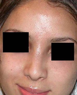 chirurgie-esthetique-interventions-nez-rhinoplasties-058