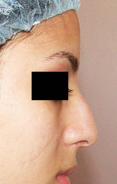 chirurgie-esthetique-interventions-nez-rhinoplasties-059