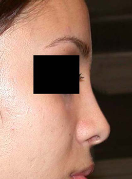 chirurgie-esthetique-interventions-nez-rhinoplasties-060