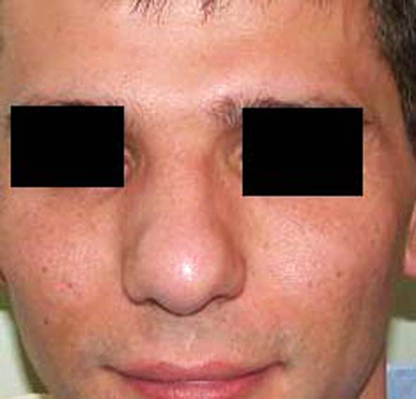 chirurgie-esthetique-interventions-nez-rhinoplasties-061