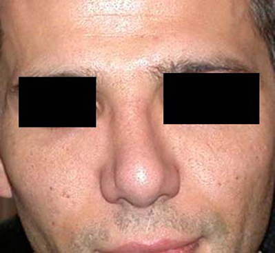 chirurgie-esthetique-interventions-nez-rhinoplasties-062