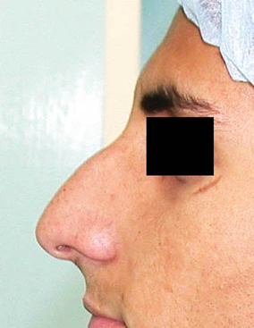 chirurgie-esthetique-interventions-nez-rhinoplasties-063