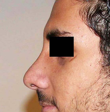 chirurgie-esthetique-interventions-nez-rhinoplasties-064