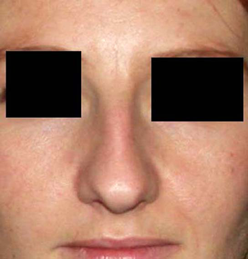 chirurgie-esthetique-interventions-nez-rhinoplasties-065