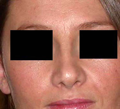 chirurgie-esthetique-interventions-nez-rhinoplasties-066