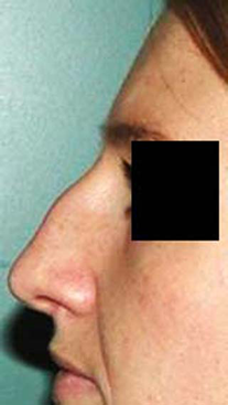 chirurgie-esthetique-interventions-nez-rhinoplasties-067