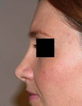 chirurgie-esthetique-interventions-nez-rhinoplasties-068