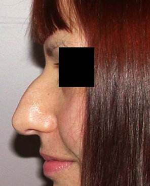 chirurgie-esthetique-interventions-nez-rhinoplasties-069