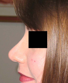 chirurgie-esthetique-interventions-nez-rhinoplasties-070