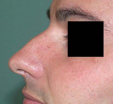 chirurgie-esthetique-interventions-nez-rhinoplasties-071