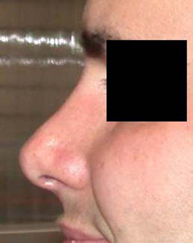chirurgie-esthetique-interventions-nez-rhinoplasties-072