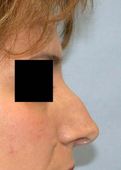 chirurgie-esthetique-interventions-nez-rhinoplasties-073