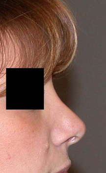 chirurgie-esthetique-interventions-nez-rhinoplasties-074