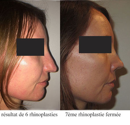 contestation-resultat-rhinoplastie-profil_drt