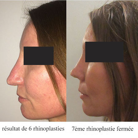 contestation-resultat-rhinoplastie-profil_gauche