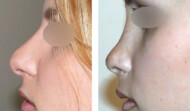 resultat_rhinoplastie_secondaire12-190x111
