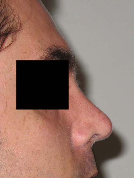 chirurgie-esthetique-secondaire-pnahon029