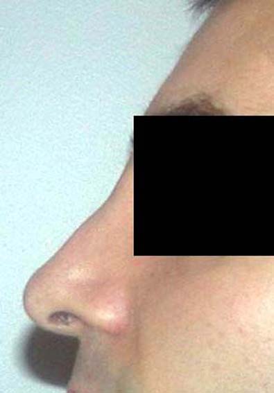 chirurgie-esthetique-secondaire-pnahon030