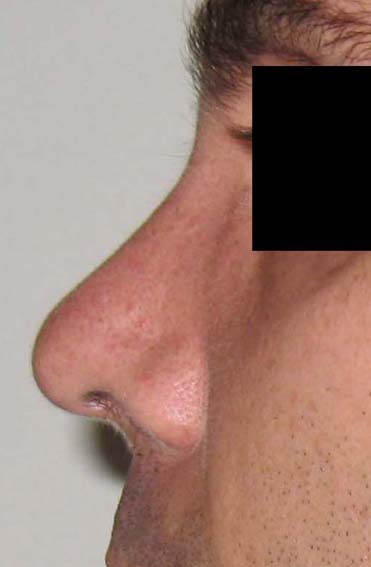 chirurgie-esthetique-secondaire-pnahon031