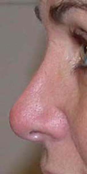 chirurgie-esthetique-secondaire-pnahon033