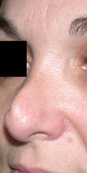 chirurgie-esthetique-secondaire-pnahon034