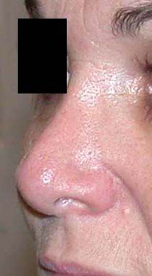 chirurgie-esthetique-secondaire-pnahon035