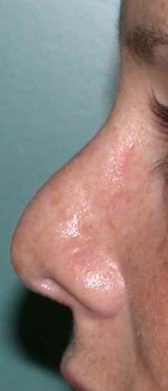 chirurgie-esthetique-secondaire-pnahon036