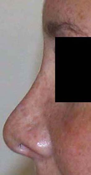 chirurgie-esthetique-secondaire-pnahon037