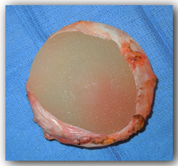 prothèse sous la capsule