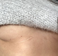 cicatrice greffon costal