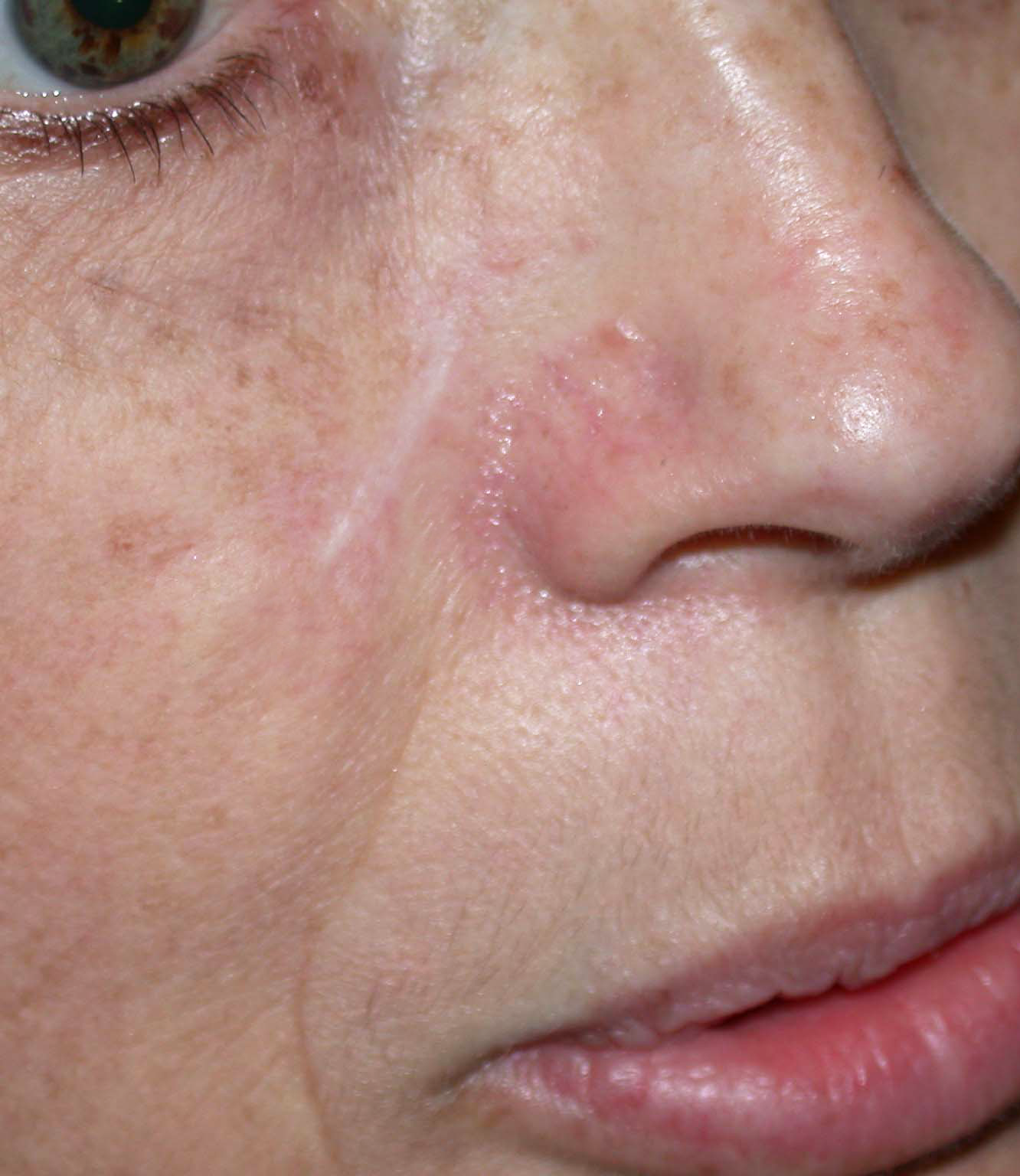 chirurgie-esthetique-cancer-cutane-joue-1