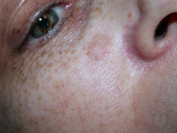 chirurgie-esthetique-cancer-cutane-joue-2