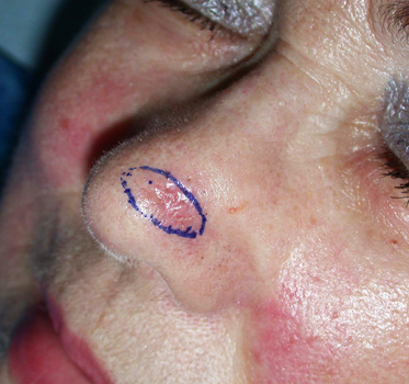 chirurgie-esthetique-cancer-cutane-nez