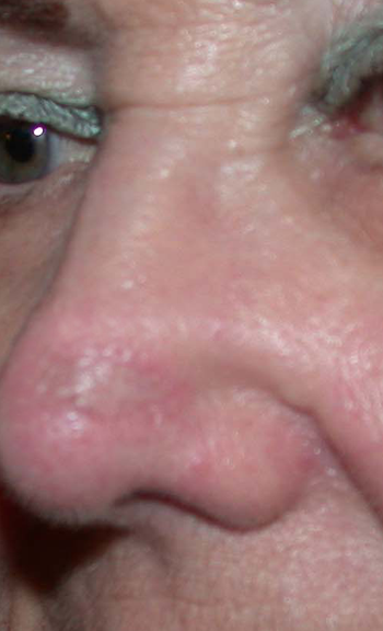 chirurgie-esthetique-cancer-greffe-resultat