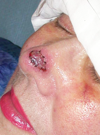 chirurgie-esthetique-cancer-greffe