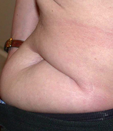 chirurgie-esthetique-interventions-cicatrices-grains-beaut-kystes-tatouages-04