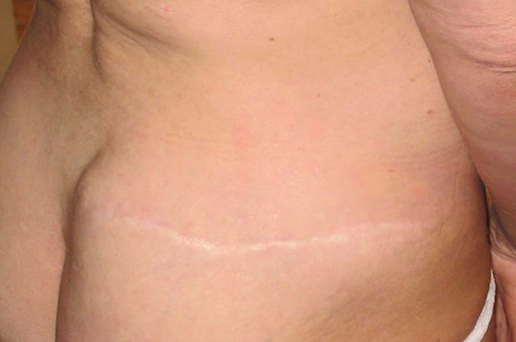 chirurgie-esthetique-interventions-cicatrices-grains-beaut-kystes-tatouages-05