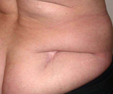 chirurgie-esthetique-interventions-cicatrices-grains-beaut-kystes-tatouages-06