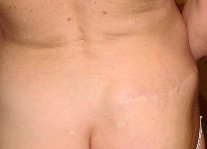 chirurgie-esthetique-interventions-cicatrices-grains-beaut-kystes-tatouages-07