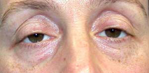 chirurgie-esthetique-interventions-paupieres-000