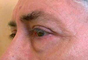 chirurgie-esthetique-interventions-paupieres-002