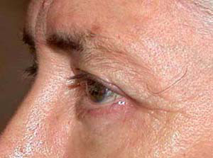 chirurgie-esthetique-interventions-paupieres-003