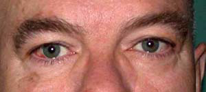 chirurgie-esthetique-interventions-paupieres-004