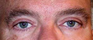 chirurgie-esthetique-interventions-paupieres-005